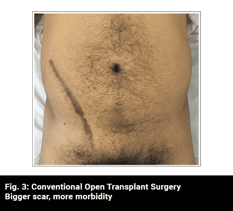 AUM - Advanced Urology Mumbai | Conventional Open Transplant Surgery
