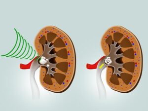 AUM - Advanced Urology Mumbai | Lithotripsy