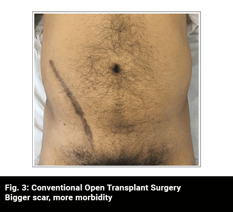 Conventional Open Transplant Surgery