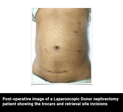 Post-operative image of a Laparoscopic Donor nephrectomy