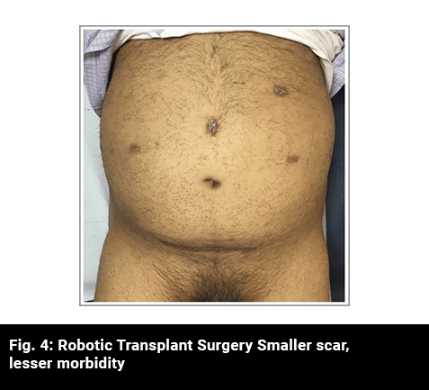 Robotic Transplant Surgery Smalled Scar