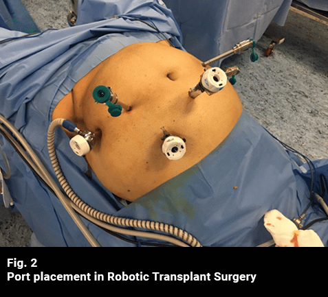 Port Placement in Robotic Transplant Surgery
