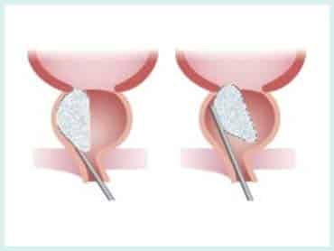 Thulium Laser Enucleation Of Prostate