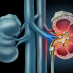 Kidney Stones: Prevention, Diagnosis, and Treatment Options